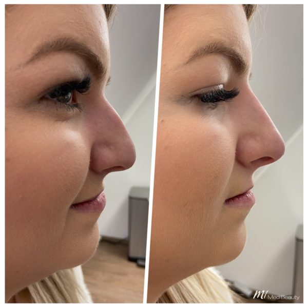 non-surgical rhinoplasty_before after result_m1 med beauty_02