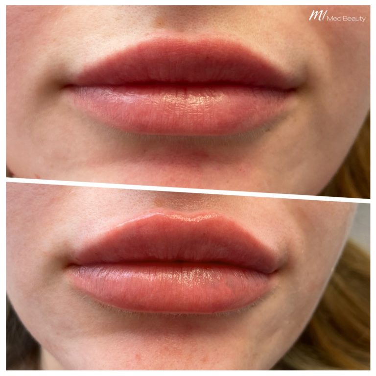 Lip fillers at M1 Med Beauty before and after 08