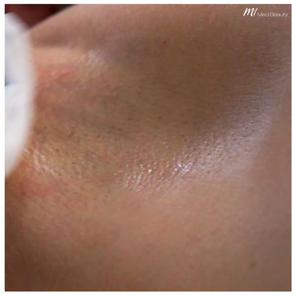 hyperhidrosis treatment armpits desinfection at M1 Med Beauty