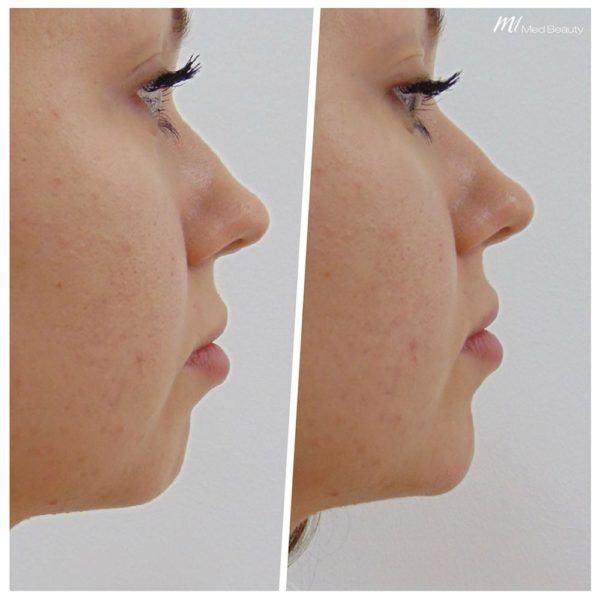 chin-filler-before-after-UK-01