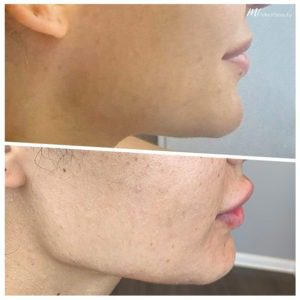 jawline filler before & after picture
