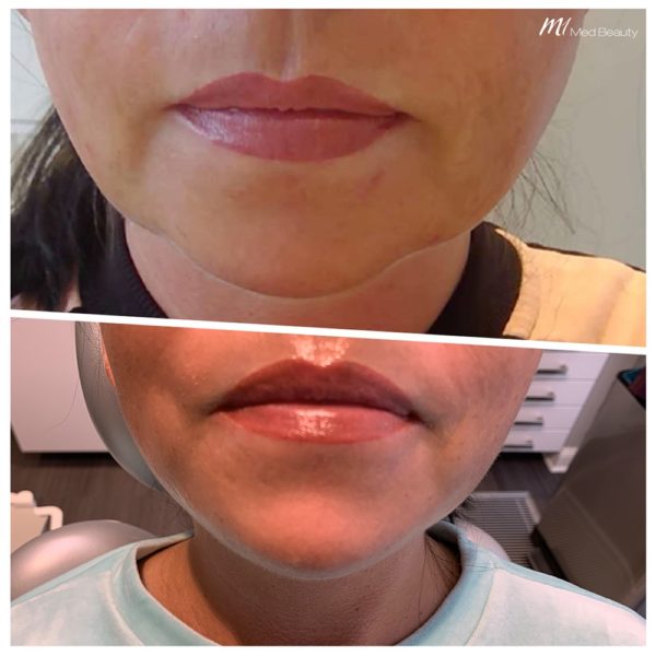 chin-filler-before-after-UK-04