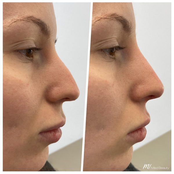 rhinoplasty before & after