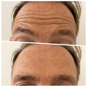 Before & after Picture forehead lines treatment
