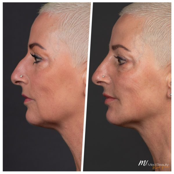 Before & After pictures - marionette lines