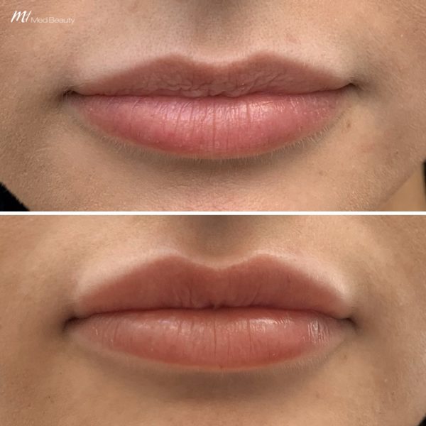 lip fillers before after image