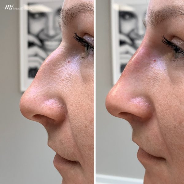 rhinoplasty before & after