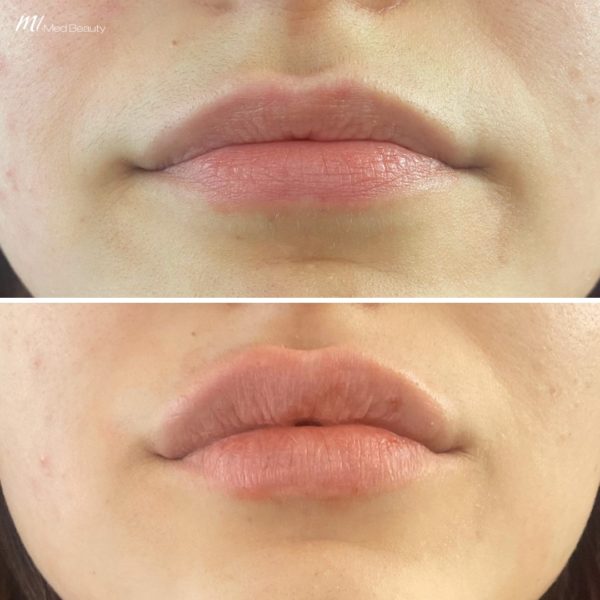 lip-filler-before-and-after-13