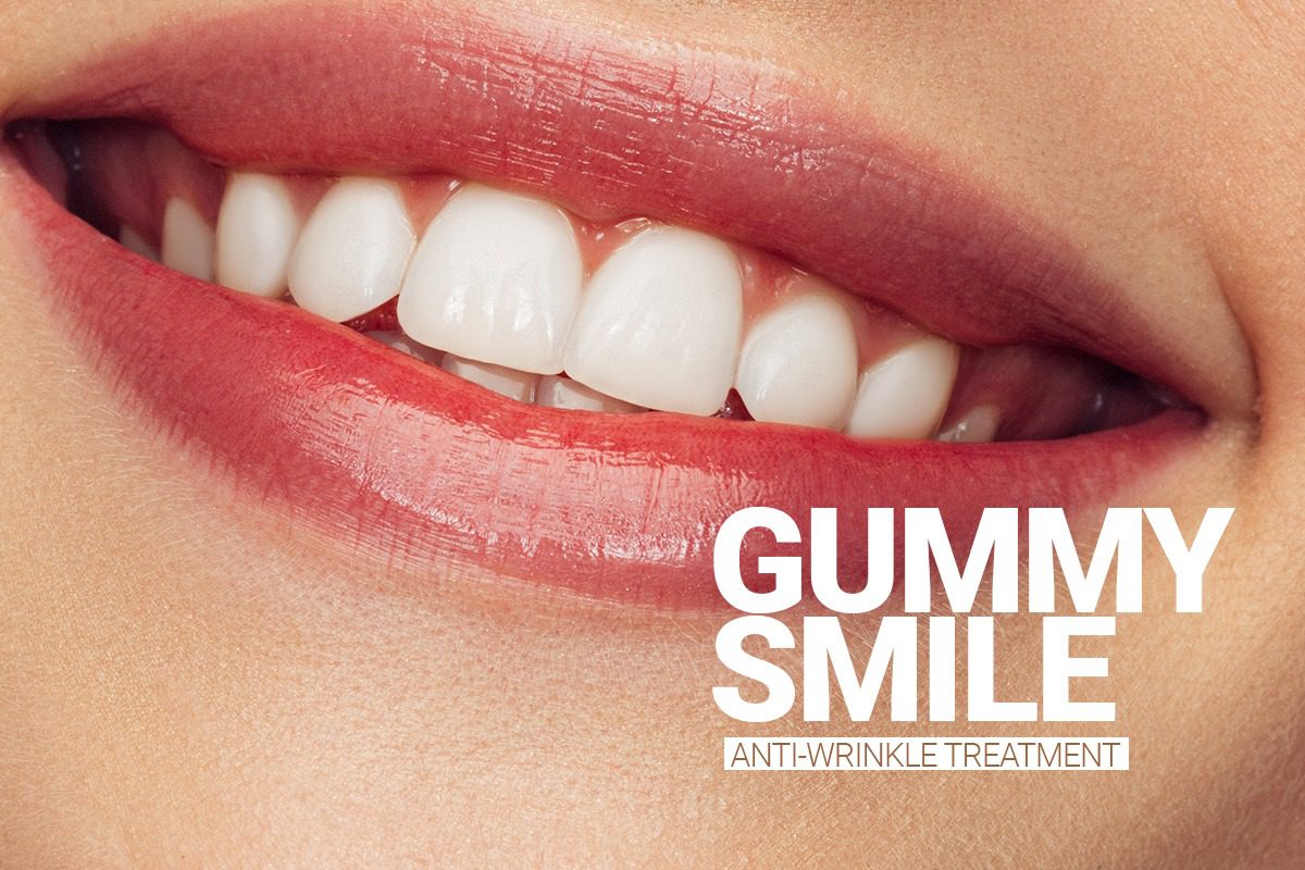 Gummy Smile Treatment