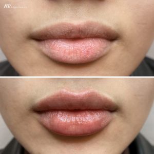 lip-filler-before-and-after-06