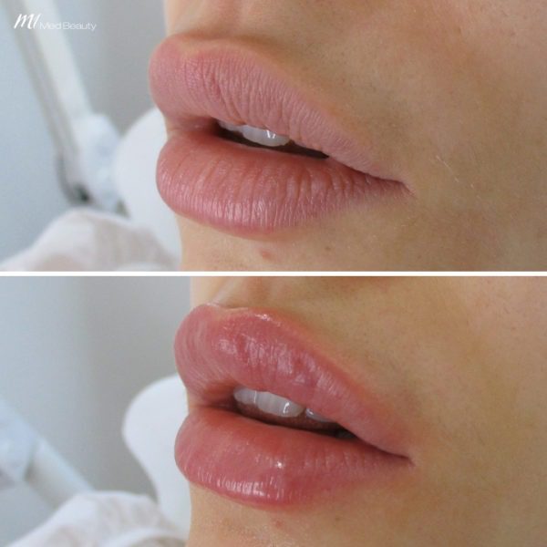 lip-filler-before-and-after
