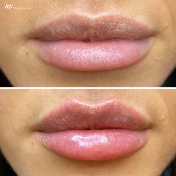 lip-filler-before-and-after-04