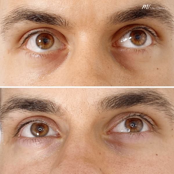 tear-trough-filler-before-and-after