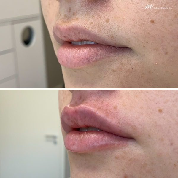 lip-filler-before-and-after