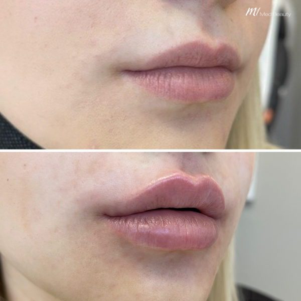 lip-filler-before-and-after-08