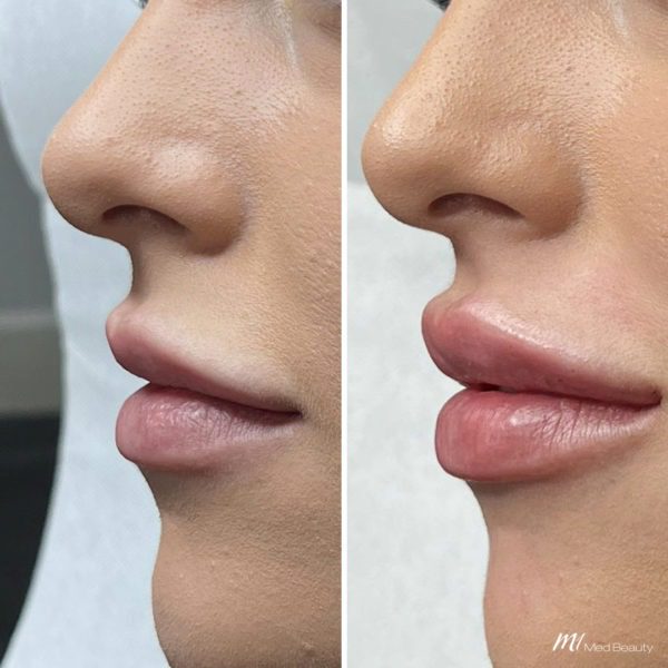 lip-filler-before-and-after-02