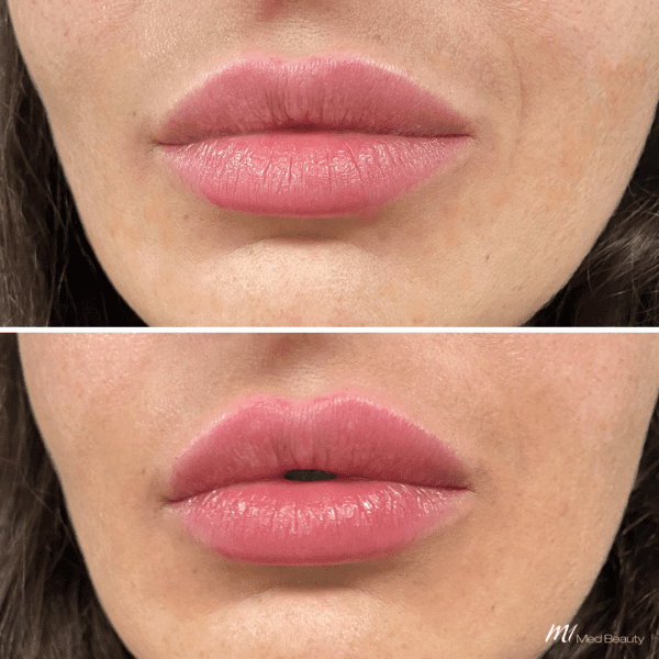 lip-filler-before-and-after-03