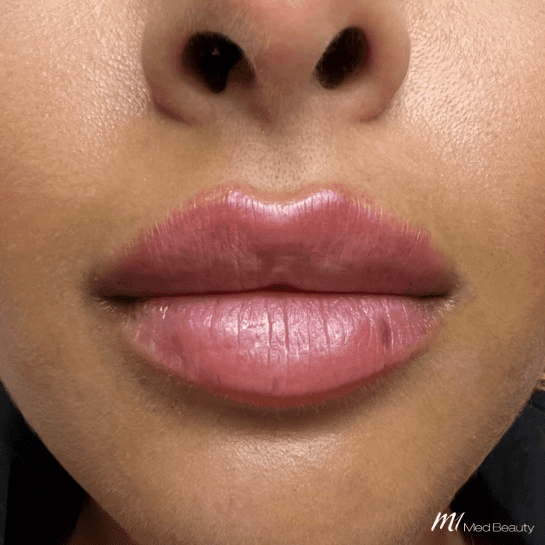 lip filler before after 4