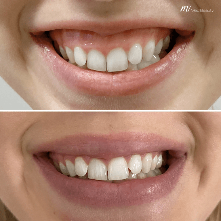gummy smile anti wrinkle before after 3