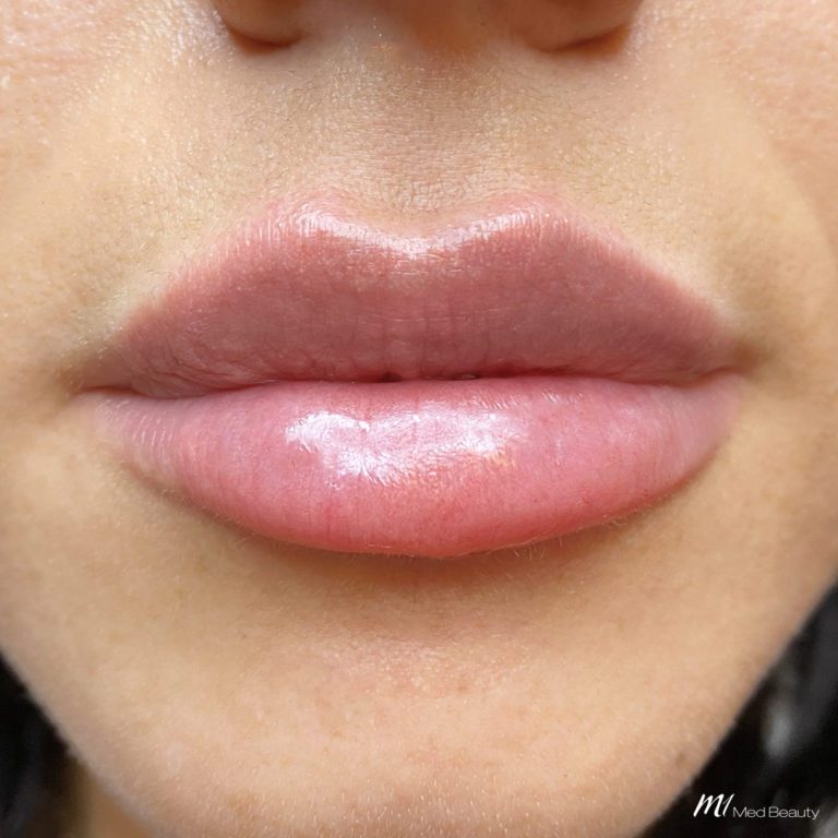 lip filler before after 10